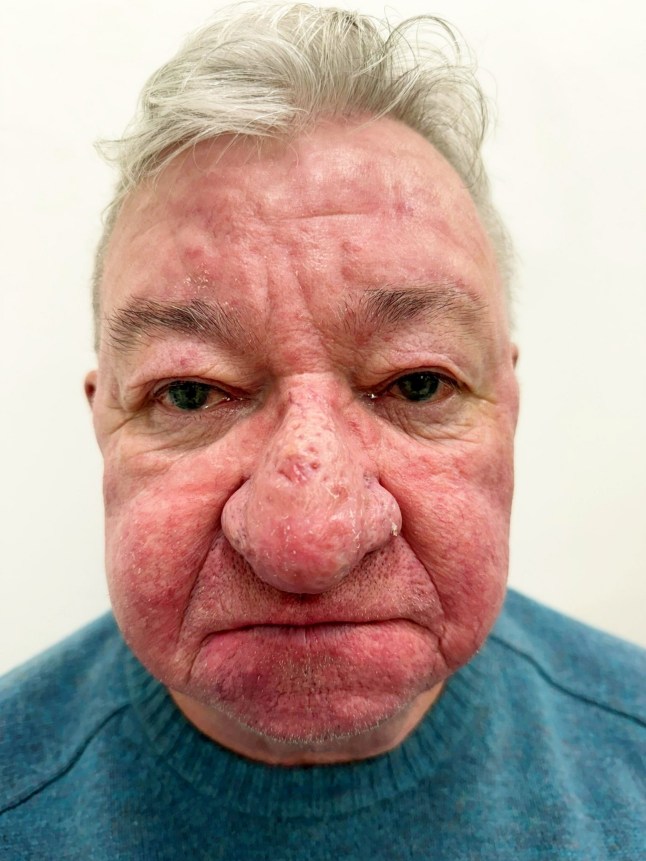 Gerard McAliece'i nina pärast ravi. // Mees ei suutnud pärast ühte oma naist suudelda "halvimad juhtumid" Ninakasvu on kliinik kunagi näinud. Kilmalcolmist pärit 68 -aastane Gerard McAliece oli kõigepealt hakanud märkama oma nina muutusi kuus aastat tagasi - kuna see hoidis "Kasvamine ja kasvamine." Ta põeb tõsist rinofüümi juhtumit - seisundit, mis on põhjustatud rasuliste näärmete levikust nina ja aluseks oleva sidekoe - põhjustatud tugeva turse, punetuse ja tükkideni. Gerardi ninas olev kude oli laienenud nii, et see rippus üle tema suu ja kattes suure osa näost. Ta oli muutunud eneseteadlikuks, närviliseks, et tema lapselapsi hinnati tema välimuse järgi - ja kasv oli takistanud tal suudelda oma naist Caroli. Foto ilmus 13.10.2025