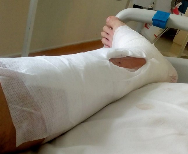 Ryan McLeodi vigastused. // Paar, kes kohtus sel ajal, kui ühte neist auto lömastas, on sõlminud sõlme ja pannud oma veidra kohtumise saatuse hooleks. Kirsty Southern märkas 2020. aasta oktoobris ujumisklassist lahkudes tulevast abikaasat Ryan McLeodi auto alla lõksus olevat ja ütles, et see oli armastus esimesest silmapilgust. 46-aastane Ryan oli just lõpetanud treeningu Corby rahvusvahelises basseinis ja jõusaalis, kui ta George Streeti ülekäigurajal navigeerida püüdes autolt löögi sai. Õnnetu juht proovis seejärel tagurdada, kuid tabas uuesti Ryanit – jäi ta sõiduki alla lõksu. Klienditeenindaja Kirsty märkas hädas Ryanit, kes tormas teda lohutama, kuid ei saanud asjaoludest hoolimata üle, kui atraktiivne ta oli. Mitu nädalat hiljem tekkis paar uuesti pärast seda, kui Ryan palus juhtunu tunnistajaid, et aga meeletult armuda. Foto avaldatud 19.10.2025