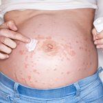 What is Implantation Bleeding and When Does It Occur?